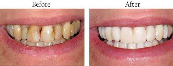 Mesa Before and After Invisalign	