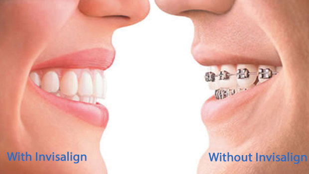 Mesa Invisalign