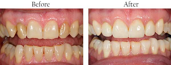 Gilbert Before and After ClearCorrect