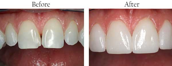 Mesa Before and After Invisalign